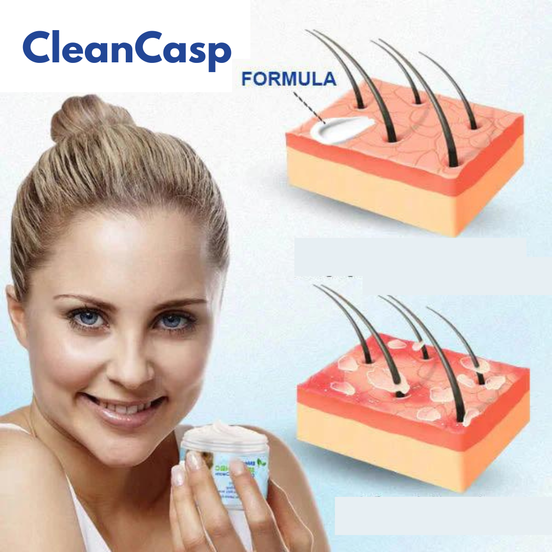 Creme para Tratamento Contra Caspas e Dermatite - CleanCasp