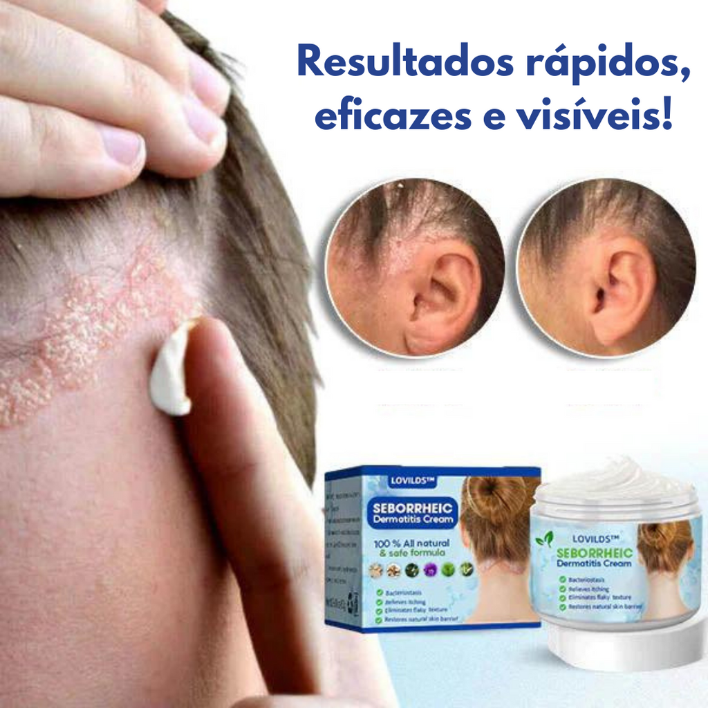 Creme para Tratamento Contra Caspas e Dermatite - CleanCasp